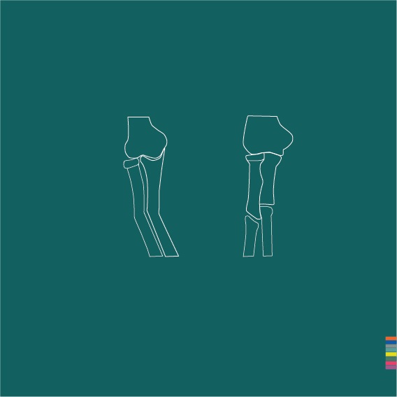 Malunion / Nonunion